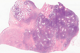 Primary Large B-Cell Lymphoma in the Testis
