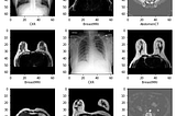 Disease Classification using Medical MNIST
