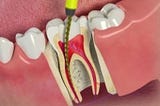 Debunking Root Canal Myths