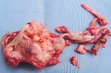 The day I had ruptured cyst removed.