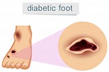 Diabetic foot care