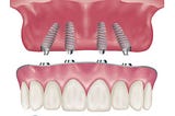 Frequently Asked Questions About Dental Implants & Periodontics