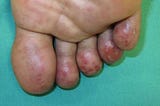 Treatments of Severe Chilblains