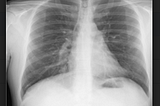 Classifying COVID-19 X-ray images