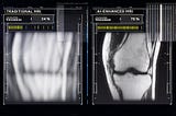 Yeni Araştırma, Yapay Zekâ ile Üretilen FastMRI Taramalarının Geleneksel MRI Kadar Kesin Olduğunu…