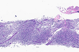 Primary Nodal EBV-Positive NK/T-Cell Lymphoma