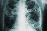 Tuberculosis: An Old Enemy, A New Fight