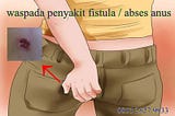 MENGAPA FISTULA SUSAH DI SEMBUHKAN