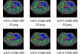 Lung CT Image Segmentation and COVID-19 Infection Detection