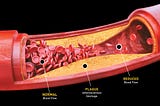 Navigating Arteriosclerosis: Causes, Symptoms, and Treatment Insights