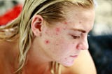 Tretinoin: Your acne buddy