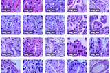 Metastatic Adenocarcinoma Classification With Lobe