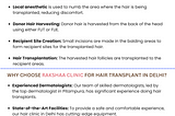 Hair Transplant in Delhi