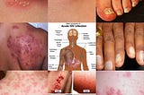 (HIV)
The human immunodeficiency virus (HIV) is a lentivirus (a subgroup of retrovirus) that causes…
