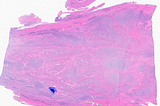 Crystal Storing Histiocytosis with Associated Plasma Cell Neoplasm