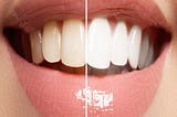 About the Ultimate Treatment of Teeth Whitening Melbourne