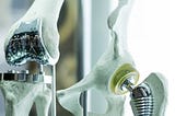 Need for Orthopedic implants and their advantages