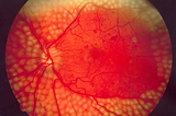 A Promising Study Revealing Co-Relation Between Vitamin C & Retinopathy.