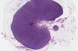 Large B-Cell Lymphoma with Background TFH-lIKE pr