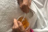 Picture of my mother’s bruised hands. She is using a plastic spoon to eat some peaches in their own juices out of a cup.