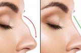 Liquid rhinoplasty- Non surgical procedure