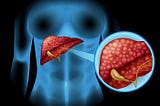 Health Conditions Linked to Alcoholic Liver Damage
