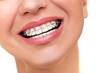 Achieving a Picture-Perfect Smile: A Guide to Braces in New York