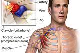 Thoracic Outlet Syndrome