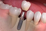 Dental Implant Treatment