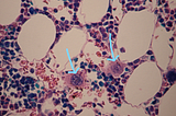 An image of a slide of bone marrow, featuring two megakaryocyte cells