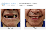 See the Great Results from Dental Tourism Patients