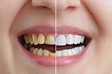 Can a dentist get rid of yellow teeth?