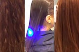 Laser Hair Treatment