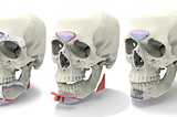 Three skulls showing locations of bone grafting/shaving for gender affirming facial surgeries