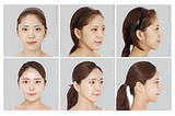 VIEW PLASTIC SURGERY: Yoo Hyun Joo; Square Jaw Reduction + Genioplasty + Cheekbone Reduction