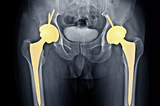Joint Implants Create Some Serious Bad Blood