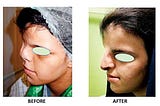 Iraqi Girl with Two Noses Undergoes a Rare Surgery in Delhi