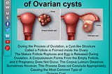 WHAT ARE THE CAUSES OF OVARIAN CYSTS