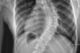 My Scoliosis Story — From a Pillow Inventor