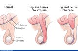 Causes and Treatment of Inguinal Scrotal Disease