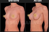 Breast Augmentation: Enhance Your Confidence and Beauty