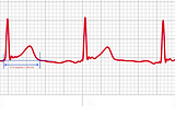 How to read your QT Interval