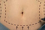 Does Fat Return After Liposuction?