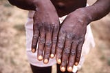 Understanding the Monkeypox Pandemic: What Every Liberian Should Know