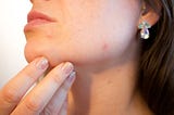 Treatment for Severe Acne and Scarring