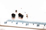 How Do You Treat The Different Sizes Of Kidney Stones Differently?