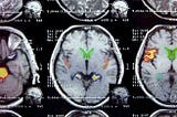 A Step-by-Step Case Study on Brain MRI Segmentation from Kaggle