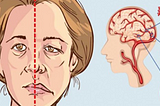 Do You know about TIS (Transient Ischemic Attack)?