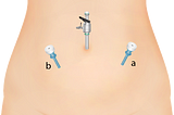 Tips and Tricks in Laparoscopic Surgery — Port Placement