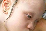 LETS STAND UP FOR ALBINOS — ALBINISM IS NOT A CURSE